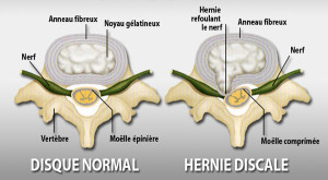 hernie-discale